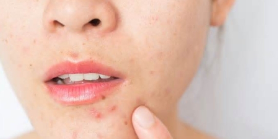 Sivilce İzi Nedir? Neden Oluşur?